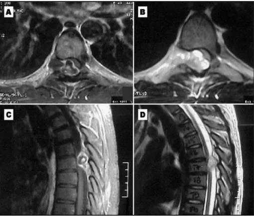 Fig 1. A) T1-weighted, gadolinium-enhanced MRI axial at the T6-T7 level; B) T2- weighted axial MRI at the same level; C) T1-weighted, gadolinium-enhanced MRI, sagittal; D)  T2-weighted sagittal MRI
