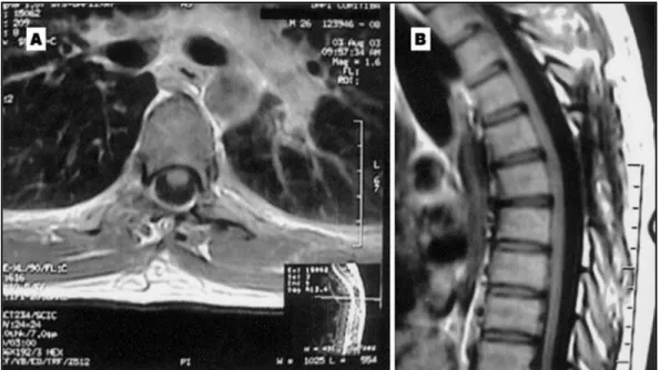 Fig 2. T1-weighted, gadolinium-enhanced MRI obtained 1 year after the complete tumor removal