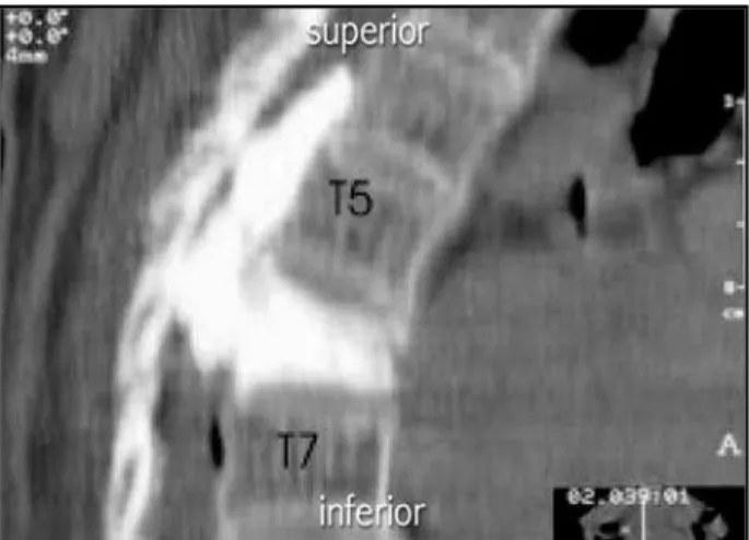 Fig 1. Sagittal CT scan of the theracic spine showing PMMA leak into the epidural space.