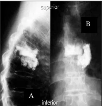 Fig 3. Lateral (A) and AP (B) postoperative plain x-ray views sho- sho-ing extravasated PMMA laterally to T6 and T7 Vertebral  bod-ies