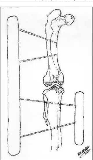 Figura 2 - Artrodese de joelho em papagaio (Amazona aestiva). Esquema demonstrando o aparelho de fixação esquelética externa transarticular.