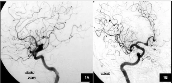 Fig 2. Lateral (1A) and anterior view (1B) of cerebral angiography showing no aneurysms, vascular malformations or vasculitis.