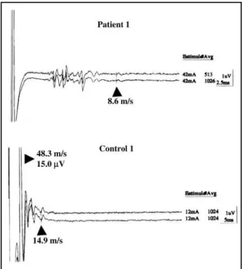 Fig 1. Near nerve recordings from the sural nerve. The upper trace shows patient 1 recording, showing absence of the main component and several abnormal intermediate components.