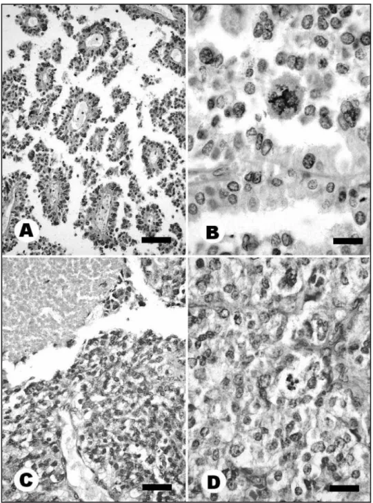 Fig 1. All sections stained with hematoxylin and eosin (HE). A and B) Well differentiated choroid plexus carcinoma: (A) cells arranged in single layer around capillaries forming papillary structures.