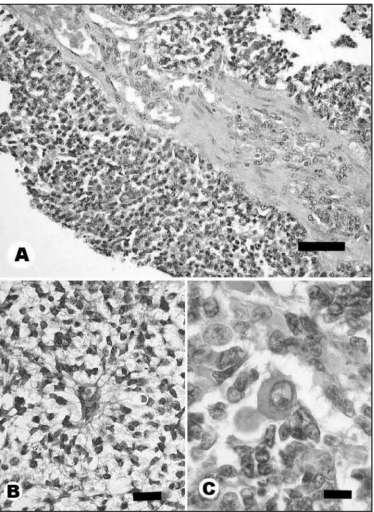 Fig 2. All sections stained with HE. Poorly differentiated choroid plexus carcinoma. (A) Area of vascular endothelial proliferation and thickening of a connective tissue septum
