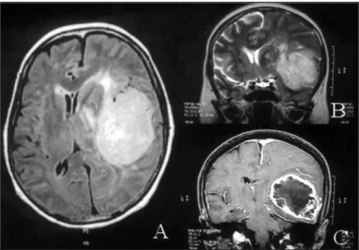 Fig 1. MR images of case 2 displaying a bulging lesion with marked peripheral edema and midline deviation localized on the fronto-parietal region (A, axial view; B, coronal view).