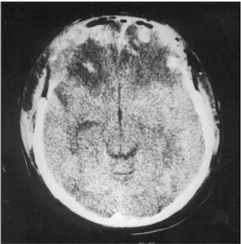 Fig 2. Serial noncontrast CT scans of patient 2. A, initial CT scan showing predominantly hemispheric swelling and midline shift.