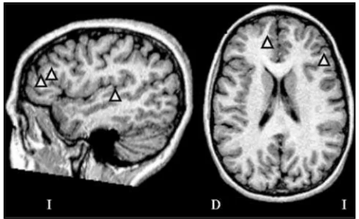 Fig 2. Dipolo correspondiente a la descarga inicial de la crisis (triángulo blanco) localizado en la circunvolución temporal inferior izquierda, cerca del área tumoral, por debajo y por detrás de la lesión.