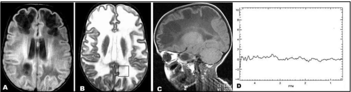 Fig 5. Vanishing white matter disease. Obvious abnormal M R signal in white matter, hypointense in T1 (a) and hyperintense in T2 weighted images (b) which corresponds to demyelinization