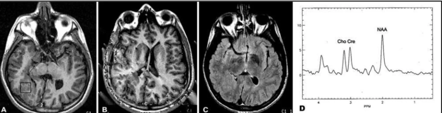 Fig 7. Type 1 neurofibromatosis and typical hypoplasic sphenoid wing (a). Basal nucleus described in this disease presents hypointense sig- sig-nal in T1 weighted images (without contrast) with a thin hyperintense peripheral ring (b), and hyperintense sigs