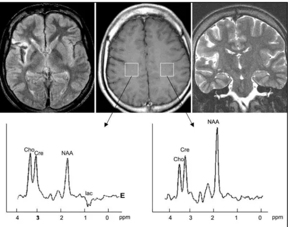 Fig 8. Rasmussen’s encephalitis. Right insular hyperintense signal in axial FLAIR (top, left) and coronal T2 (top, right) weighted images with parenchyma  retraction, noted by cortical sulci asymmetry