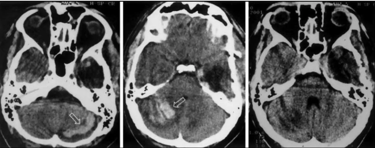 Fig 1. Patient 1: bilateral cerebellar hemorrhage.