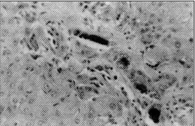 Figura 2 - Vacuolização de hepatócitos da região centrolobular e mediozonal em um bovino com fotossensibilização  he-patógena do surto 19