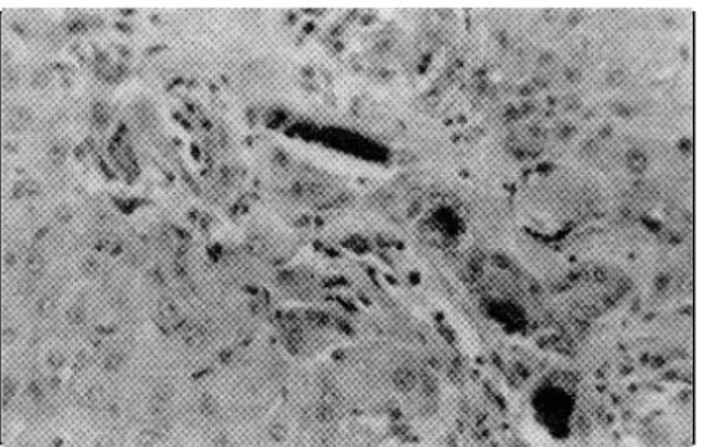 Figura 3 - Fibroplasia, discreta proliferação de células de ductos biliares e retenção biliar intracanalicular em um  bovi-no com fotossensibilização hepatógena do surto 19