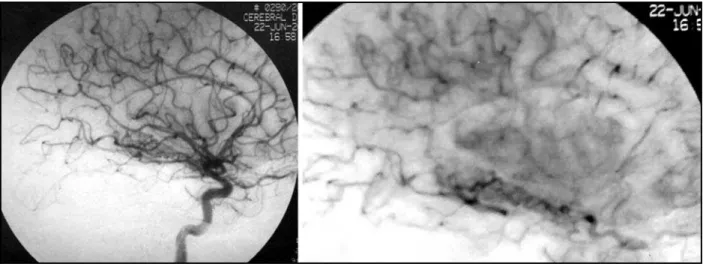 Figs 2 and 3. Cerebral angiography showing the arteriovenous malformation, supplied by the anterior choroidal artery.