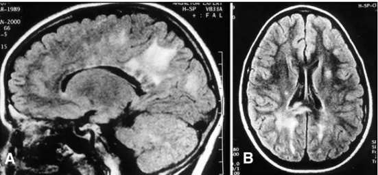 Fig 2. Fast Spin Echo Heavy T 2 -Weighted sequence shows an extensive hyper- hyper-intense lesion involving the spinal cord from the low cervical level (not shown) to the conus with mild mass effect.