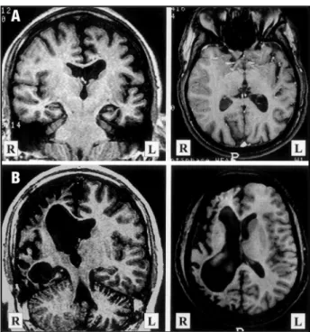 Fig 2. Examples of two kinds of cystic lesions showing differ- differ-ent effects over the adjacdiffer-ent skull