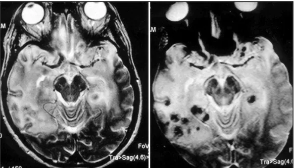 Fig 2. Axial T2-weighted MR image demonstrates areas of T2-hyperintense sign in both frontal and tempo- tempo-ral lobes as well as signs of hemorrhages.