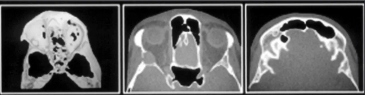Fig 1. CT showing lesions in the superior and lateral walls of the orbit and right frontal bone.