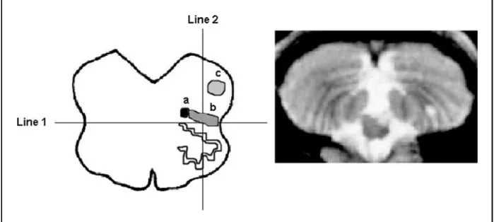 Fig 1. Left. Schematic re p resentation of the middle portion of the medulla. Line 1 divides the hemi-medulla in anterior and posterior regions and line 2, in medial and lateral regions