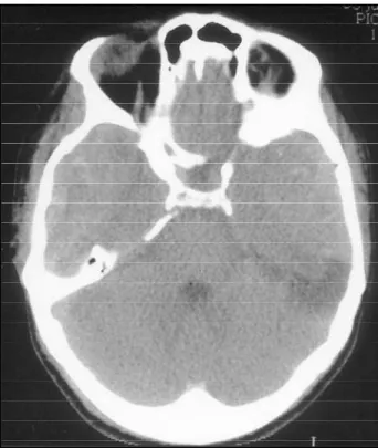 Fig 1. Bilateral isodense epidural hematoma.