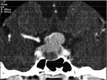 Fig 1. A computed tomography scan of pituitary gland per - -formed on March 1995 exhibiting a space-occupying lesion in sella turcica, invading suprasellar cistern.