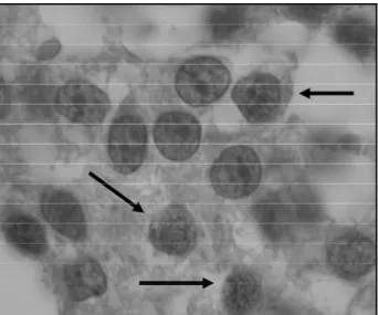 Fig 3.  Positiveness  for MIB-1  on  immunostaining  is re p re s e n t e d by some bro w n - c o l o red nuclei (metastasis, magnification X 400).