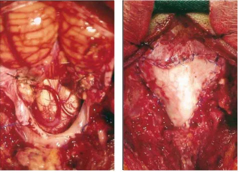 Fig 2. Dissection of the cerebellar tonsils with herniation up to C3, during the oper  -ation in sitting position.