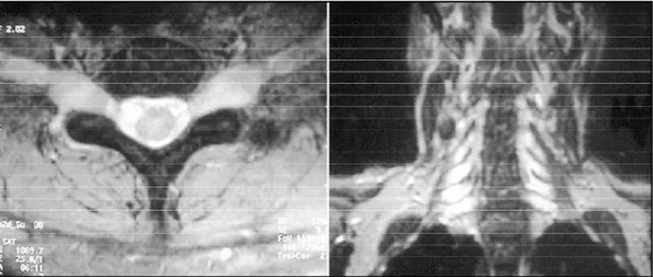 Fig 1. Case 1. Axial and coronal T2 weighted cervical spinal MRI showing roots hypert ro p h y.