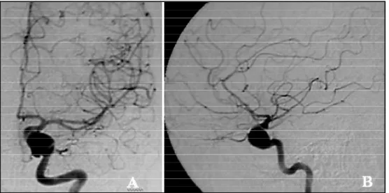 Fig 2. Angiography demonstrating the thrombosed aneury s m inside the left cavernous sinus and a good perfusion of the ipsi  lateral hemisphere through posterior circulation, after an endo  vascular trapping of the cavernous segment of the left inter  -nal
