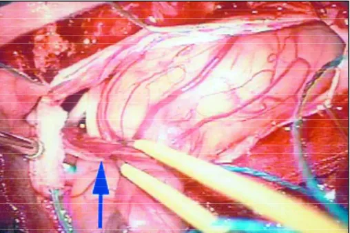 Fig 2. Intra-operative image show - ing the cystic lesion after separa  -tion from the roots by blunt micro dissection