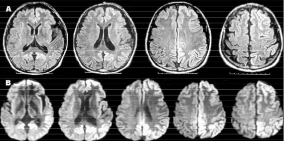 Fig 1. Brain MRI study showing gyriform hyperintensity on FLAIR (A) and diffusion-weighted images (B) involving the left cortical ribbon and the right posterior cingulate gyrus.