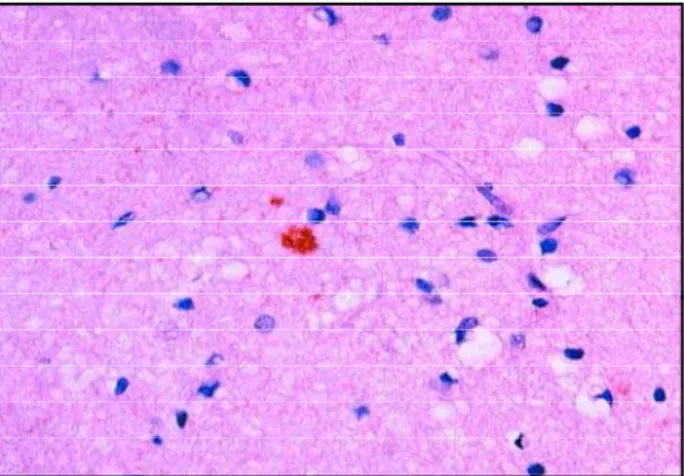 Fig 2. Cerebral cortex with moderate neuronal loss and spon - -giform change (HE X 250).