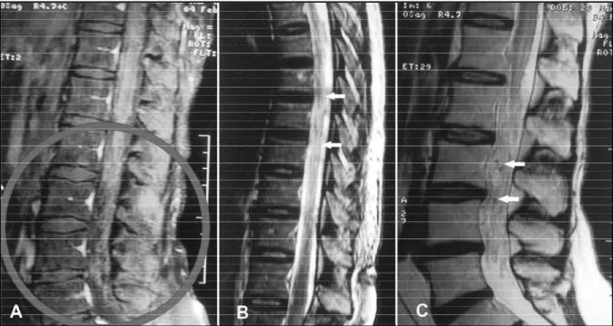 Fig 1. A) Lombosacral T1-weighted with gadolinium MRI shows tortuous vessels involving the caudal equina spinal roots with conus medullaris contrast enhancement (circle)