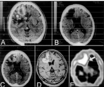 Fig 1. Right side frontal tumoral lesion before (A) and after (B) surgery. Reoccurrence of tumoral mass shown by CT scan (C), MRI (D), and SPECT scan (E).