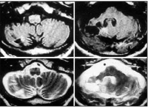 Fig 1. FLAIR (top; TR = 8402 ms; TE = 142 ms) and T2-weighted (bottom; TR = 4500 ms; TE