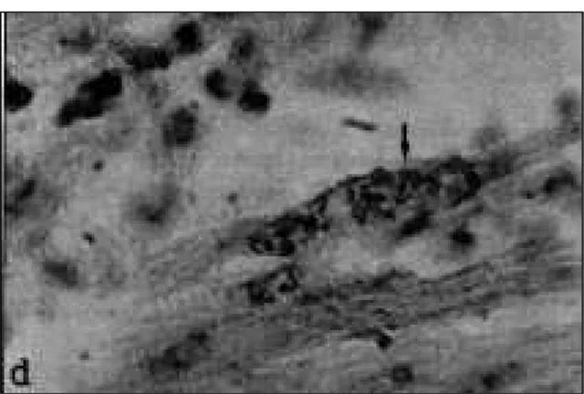 Figura 5 - Necrose focal contendo taquizoítos (ponta de seta) marcados com anticorpos anti-Neospora caninum