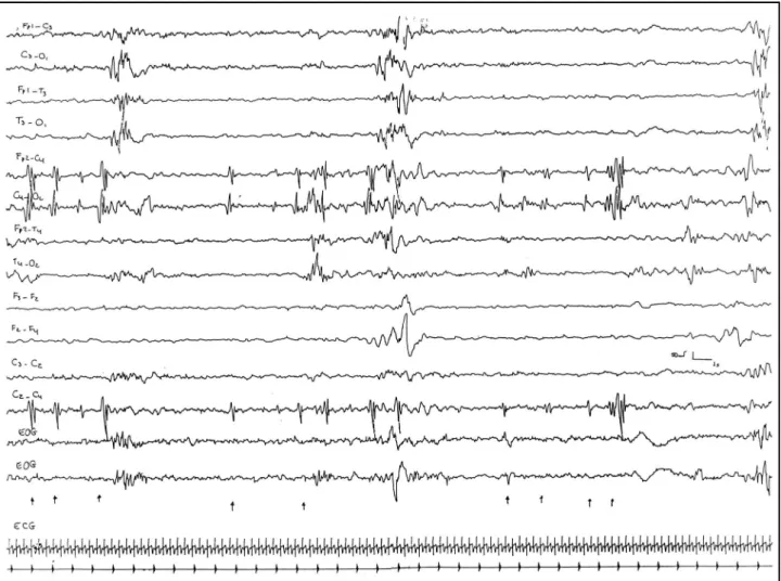Fig 1. Neonatal EEG showing burst suppression pattern in a newborn with multiple seizures type, refractory to antiepileptic drugs.