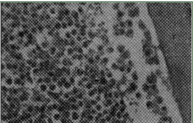 Figura 2 - Leucemia mielomonocítica aguda. Medula óssea: densamente preenchida por células blásticas com pouco citoplasma, núcleo redondo ou chanfrado, nucléolo proeminente e cromatina  fina, moderada quanti dade  de neutrófilos e alguns megacariócitos