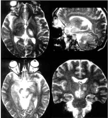 Fig 1. Cranial MRI (T2-weighted) showing hyperintensities in t h e left thalamus (a, b), cerebellum (b) and midbrain (c, d).