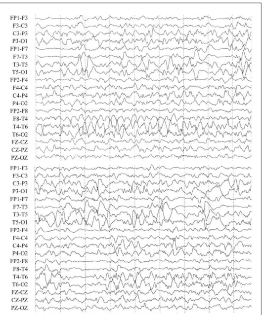 Fig 1. EEG tracing showing dis - o rganized background activi  -ty and electrographical seizure characterized by ictal rh y t h m in  the theta band s t a rting at the right midposterior tempo  -ral region.