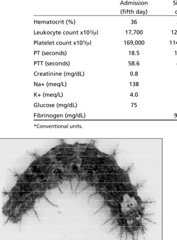 Fig 2. Ct-scan imaging with multiple intracerebral hemorrh a g e s .