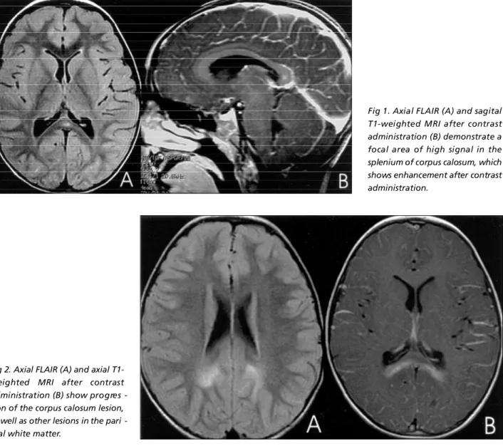 Fig 1. Axial FLAIR (A) and sagital T1-weighted MRI after contrast administration (B) demonstrate a focal area of high signal in the splenium of corpus calosum, which shows enhancement after contrast administration.
