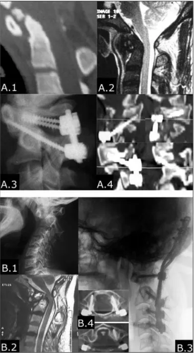 Fig 3. A.1 and A.2: C-spine sagital reformatted CT scan and MRI scan showing an os odontoideum associated with C1-C2  subluxa-tion and spinal cord compression; A.3: Postoperative C-spine  lat-eral X-ray showing a three-point construct with C1-C2  transarti
