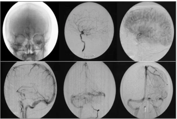 Fig 1. CT scan showing calcified expanding process at the pineal region. 