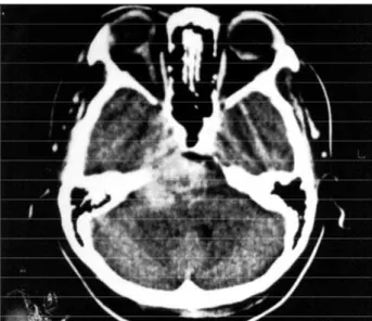Fig 1. Cerebral tomography with right trigeminal nerve lesion.
