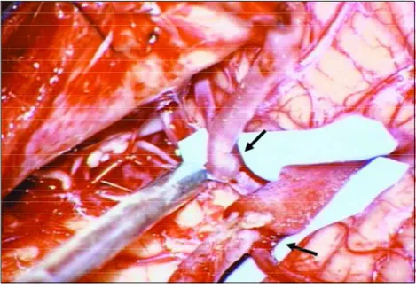 Fig 2. Intraoperative picture showing the bilateral occipital to PICA bypasses (arro w s ) .