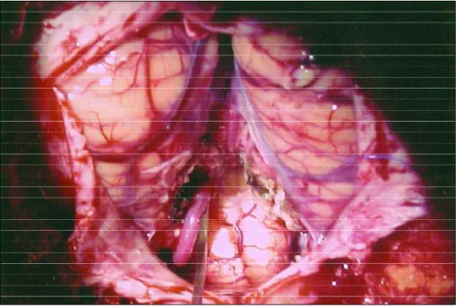 Fig    2. To n s i l e c t o m y,  large  opening of the fourth ventricle and the Left PICA.