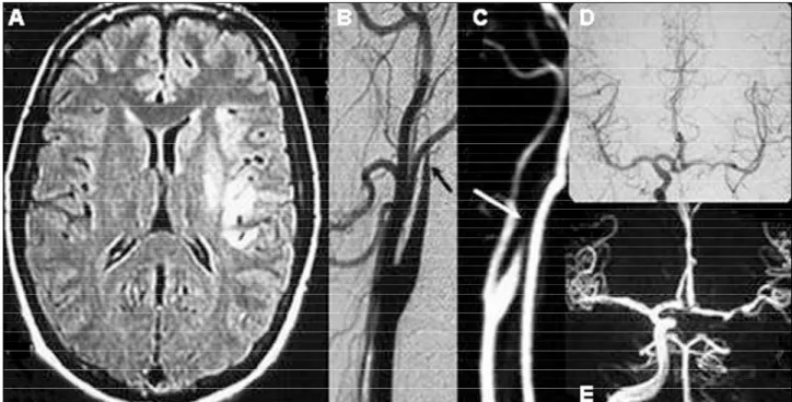 Fig 1. Patient 1, a 26-year-old male, had sudden onset of headache, nausea, right hemiparesis and dysarthria after sexual inter - -course