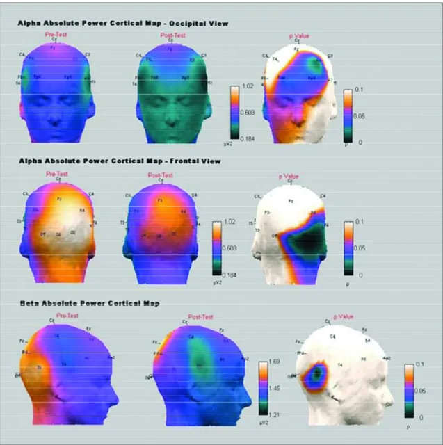 Fig 1. Alpha absolute power cortical map showing both frontal and occipital views. One night of sleep deprivation caused a significant power decrease in frontal, temporal and occipital areas in this frequency band